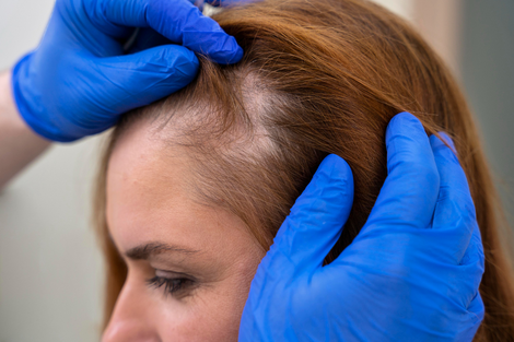 Alopecia Treatment