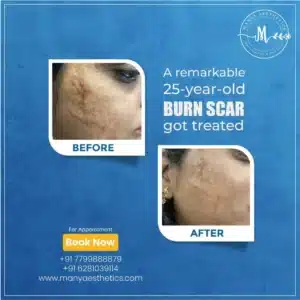 Acne treatment in Hyderabad 