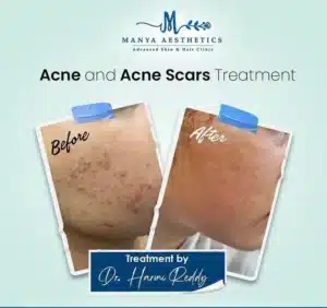 Acne scar treatment before and after photo