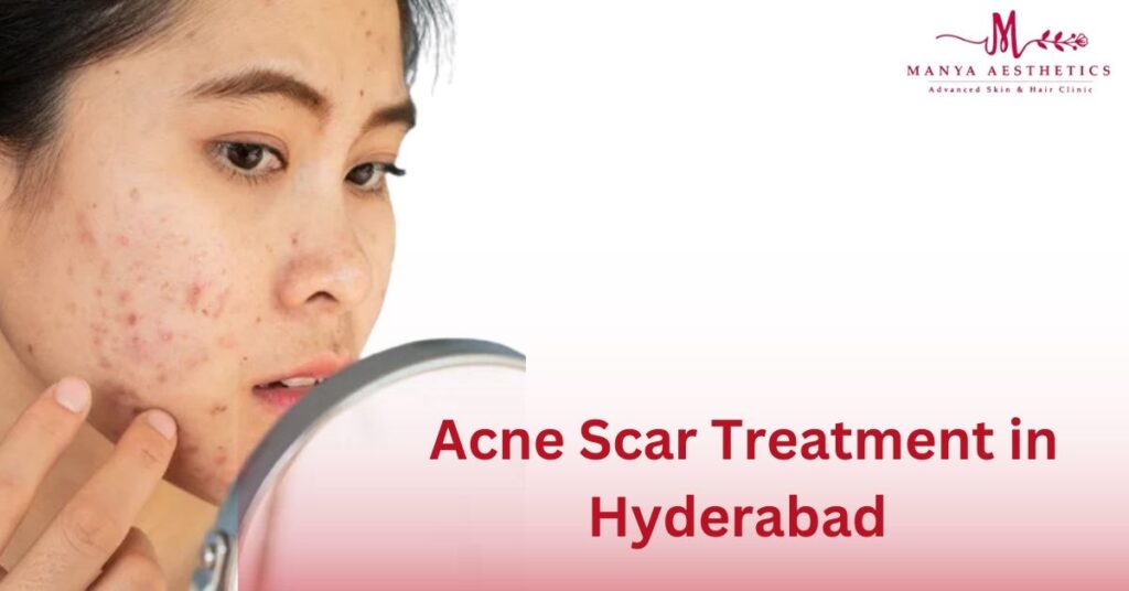 Acne Scar Treatment in Jubilee Hills, Hyderabad