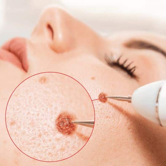 warts removal treatment hyderabad