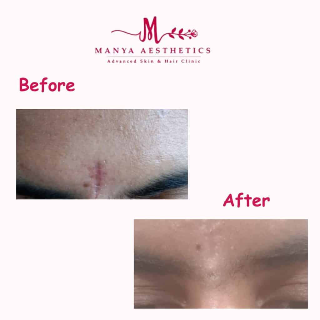 Skin Marks Removal Treatment