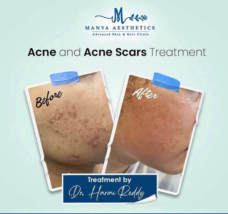 Acne Scare treatment in Hyderabad